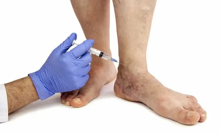 تزریق جوانسازی پا توسط دکتر متخصص 14565