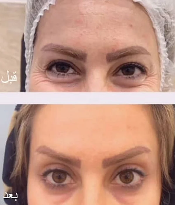 تزریق بوتاکس صورت در گرگان 584153521021