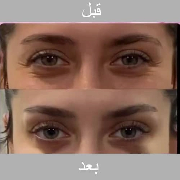 تزریق بوتاکس صورت در شهر گرگان 5842152521021