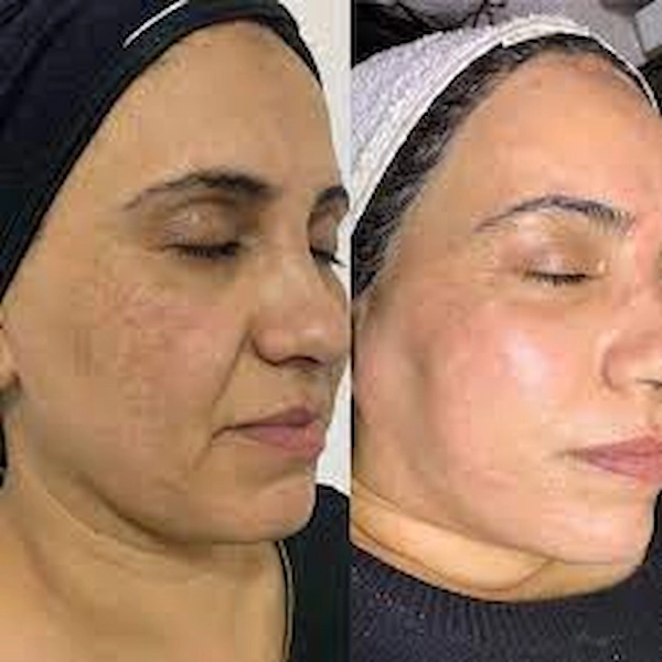 نمونه فیشیال روشن کننده پوست در کلینیک بیوتی گرگان 52468453150