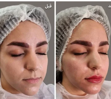 نمونه کار تغییر فرم لب و چانه با تزریق فیلر در گرگان 5098695406