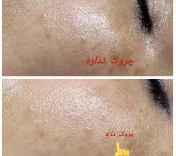 فشیال پوست در گرگان 058640564