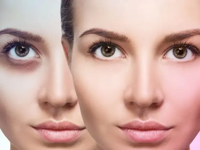 درمان سیاهی زیر چشم 0584954354